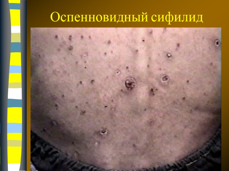 09.12.2017 Оспенновидный сифилид